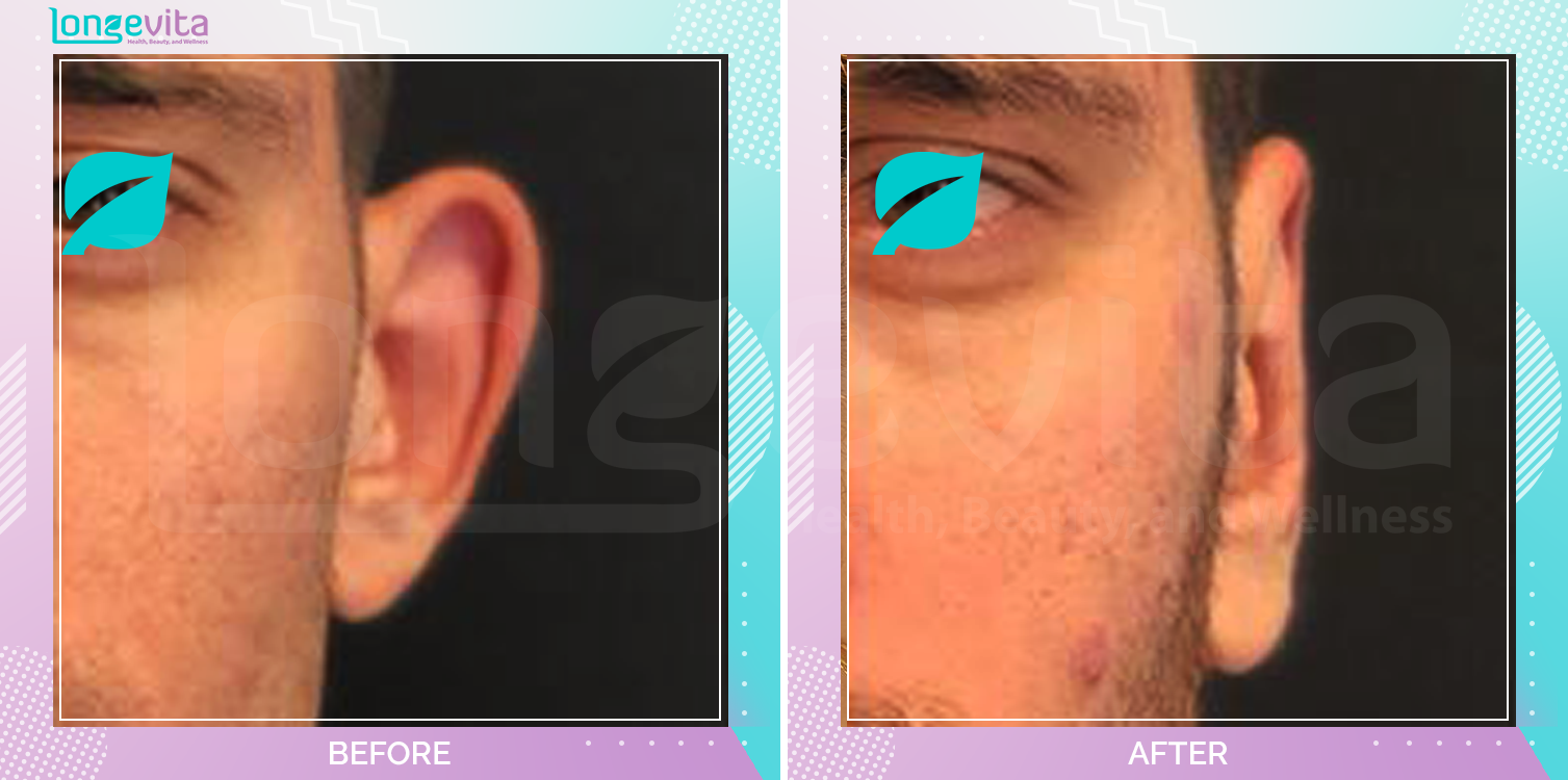 Otoplasty before and after, Face