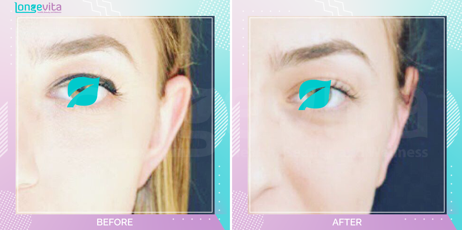 Otoplasty before and after, Face