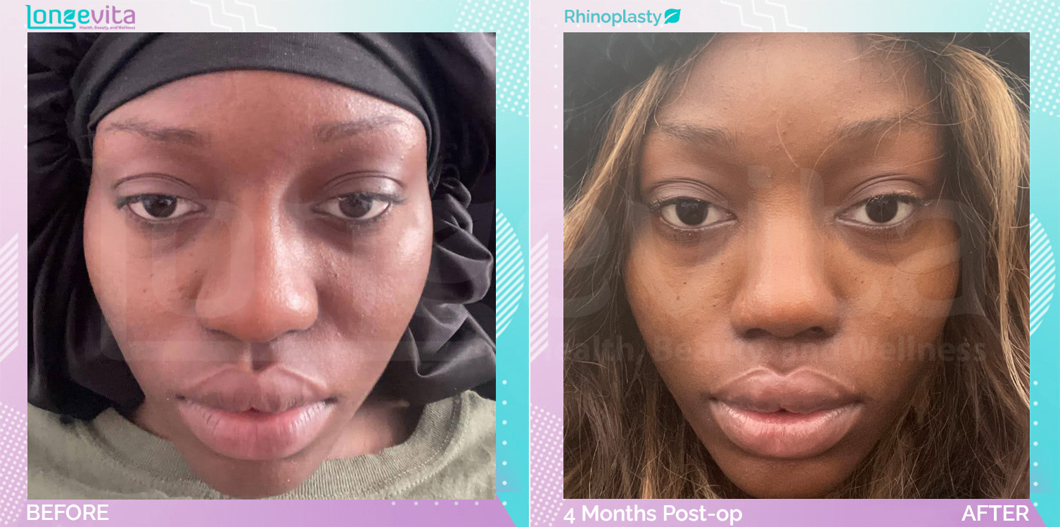 Rhinoplasty before and after, Face, 20s female patient