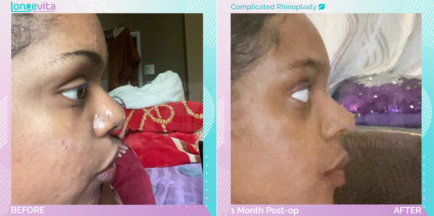 Complicated Rhinoplasty before and after, Face, 20s female patient