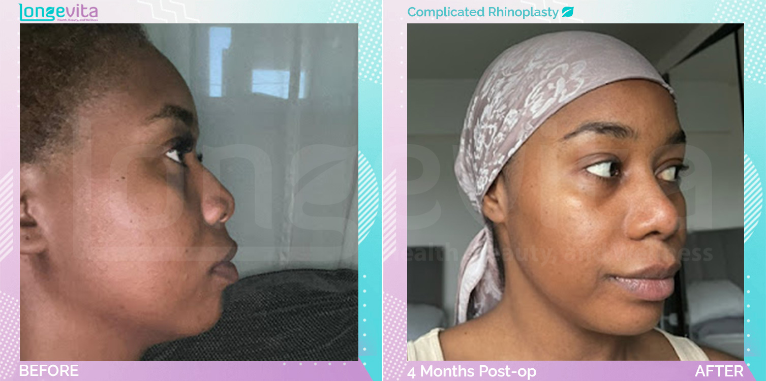 Complicated Rhinoplasty before and after, Face, 20s female patient