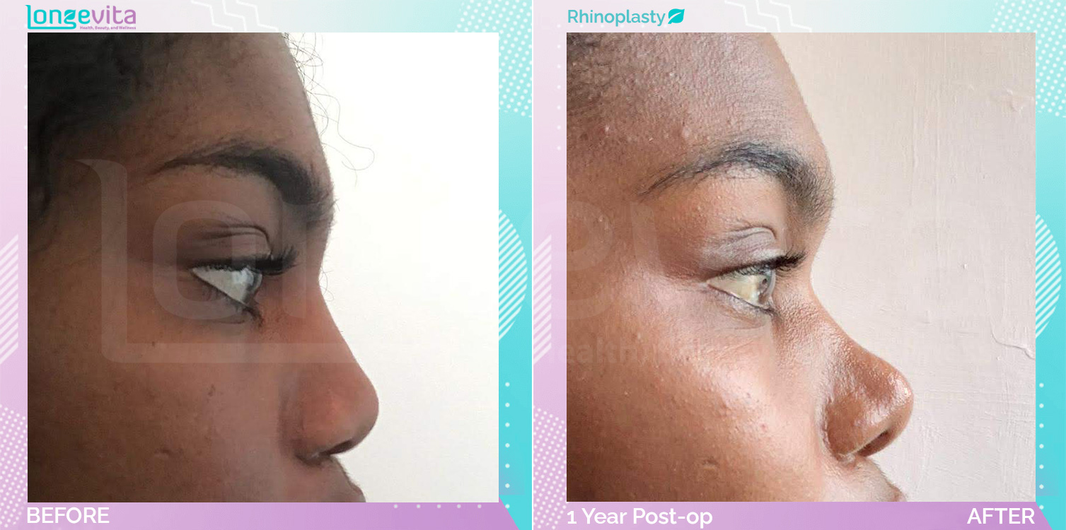 Rhinoplasty before and after, Face