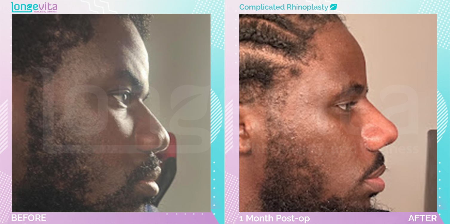Complicated Rhinoplasty before and after, Face, 20s male patient