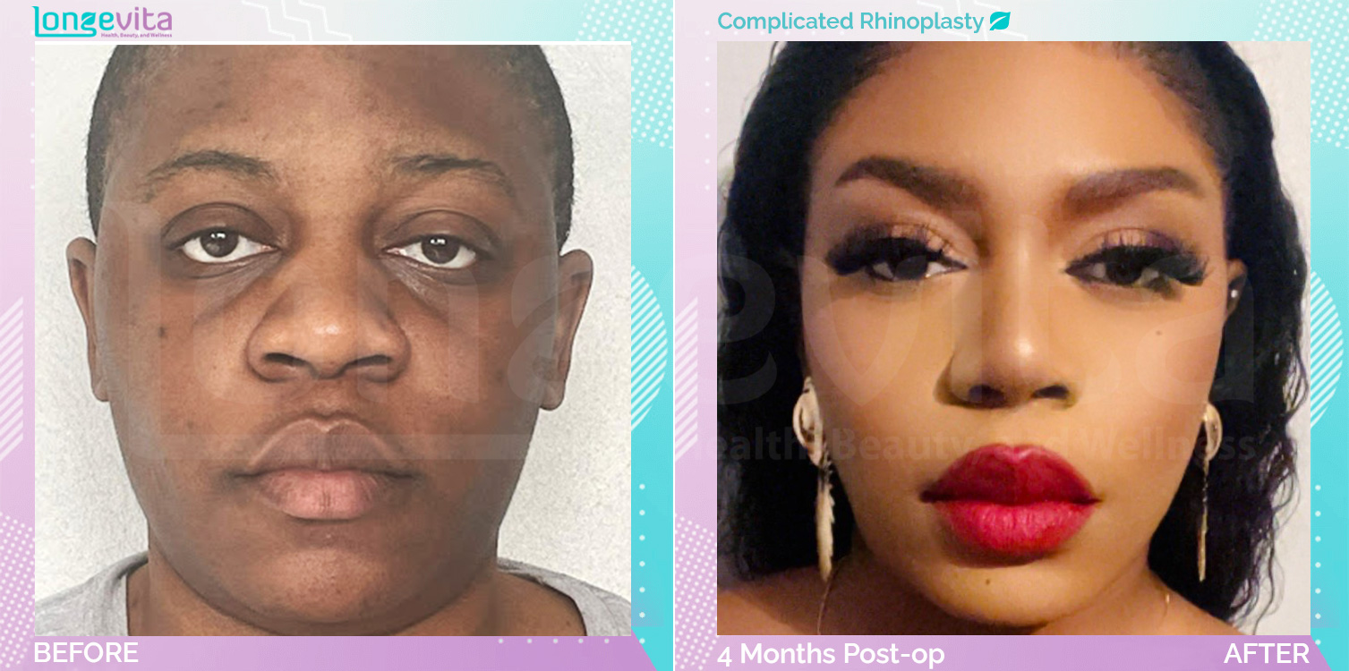 Complicated Rhinoplasty before and after, Face, 20s female patient