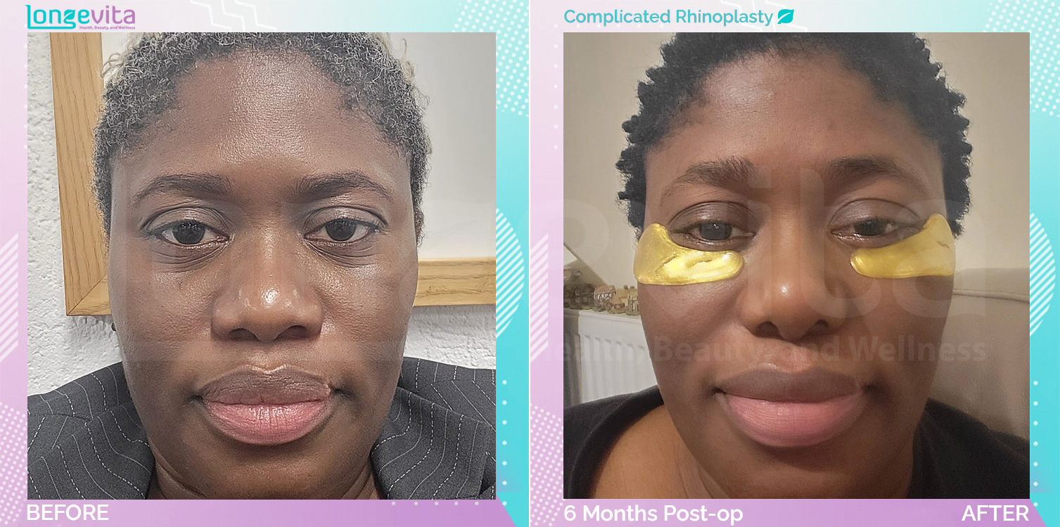 Complicated Rhinoplasty before and after, Face, 30s female patient