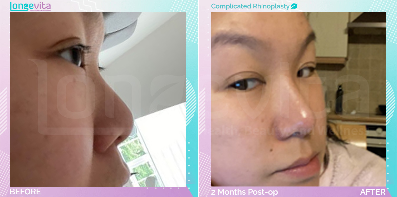 Complicated Rhinoplasty before and after, Face, 30s female patient