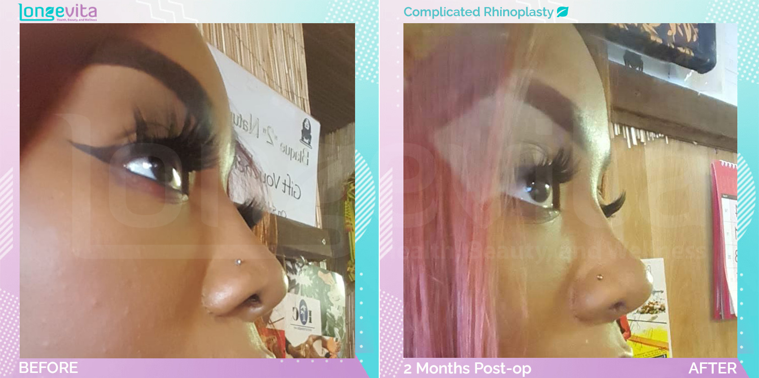 Complicated Rhinoplasty before and after, Face