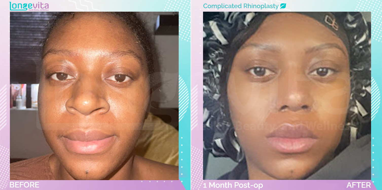 Complicated Rhinoplasty before and after, Face, 20s female patient