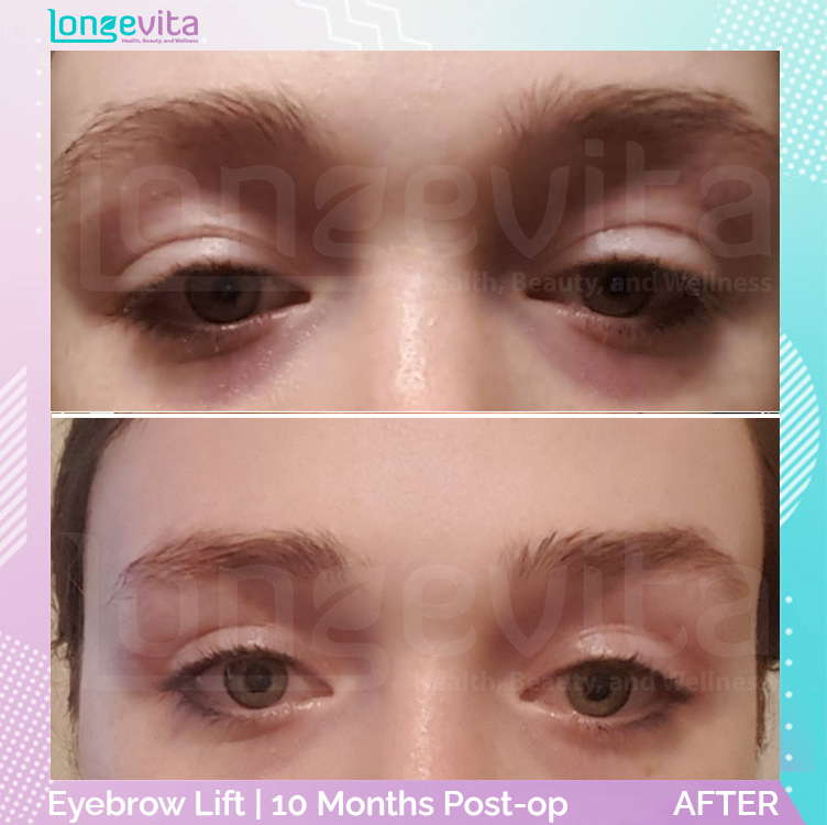 Eyebow Lift before and after, Face, 20s female patient