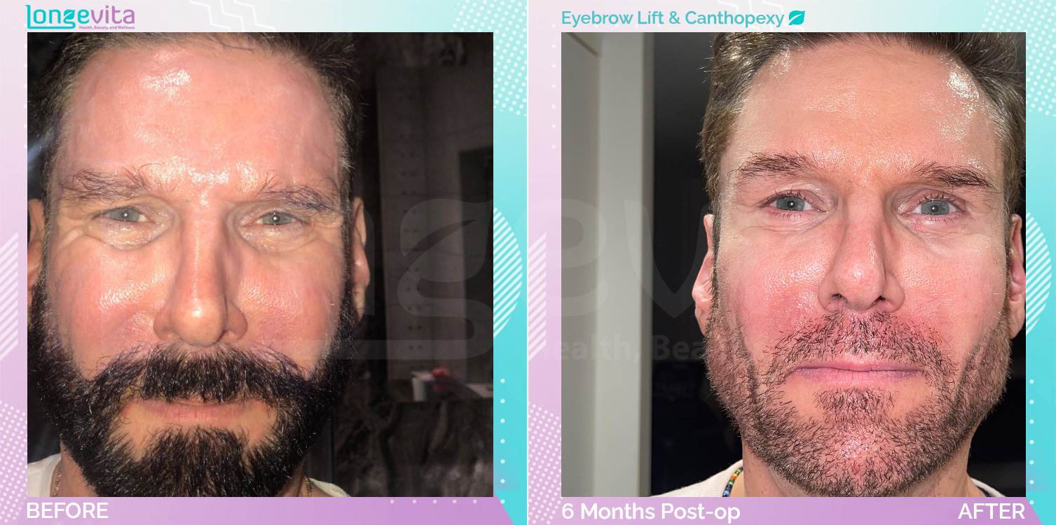Canthopexy and Eyebow Lift before and after, Face, 50s male patient
