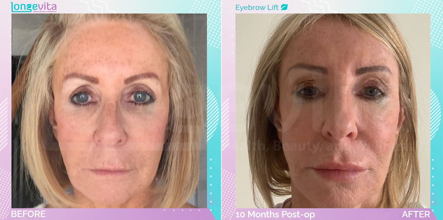 Eyebow Lift before and after, Face, 50s female patient