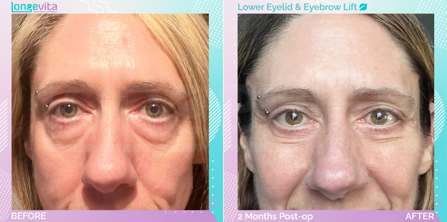 Eyebow Lift and Eyelid before and after, Face, 40s female patient