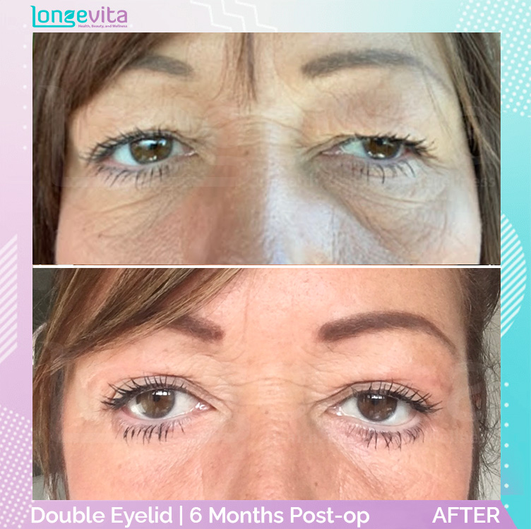 Eyelid before and after, Face, 50s female patient