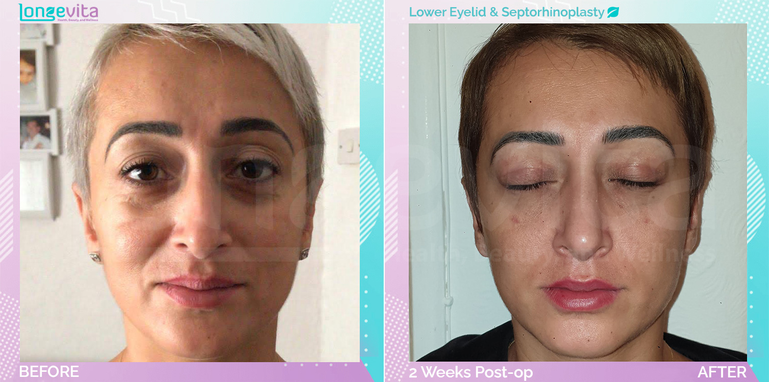 Eyelid and Septorhinoplasty before and after, Face, 30s female patient