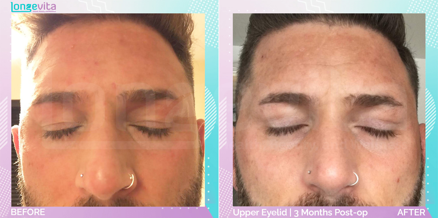 Eyelid before and after, Face, 30s male patient
