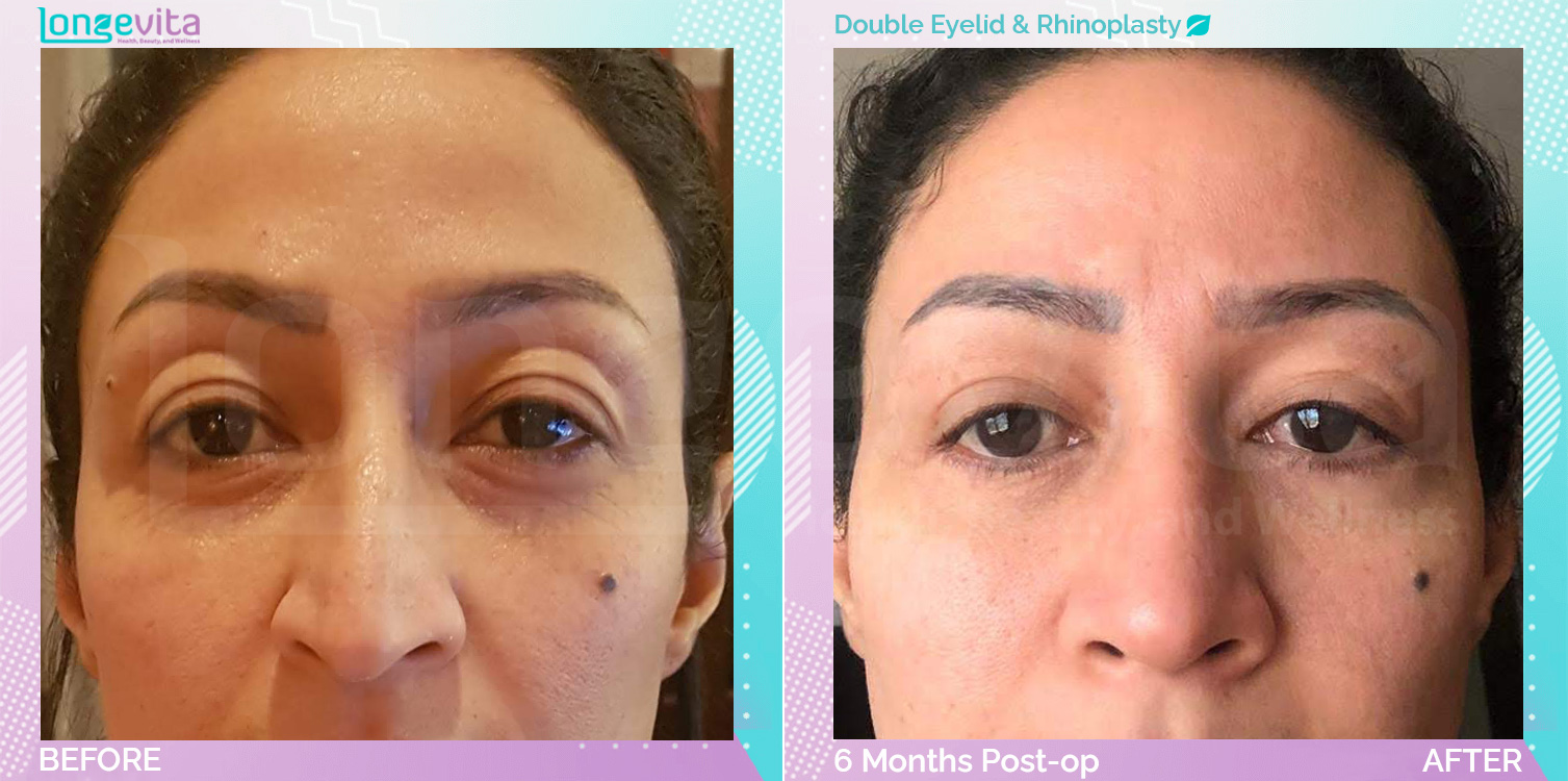 Eyelid and Rhinoplasty before and after, Face