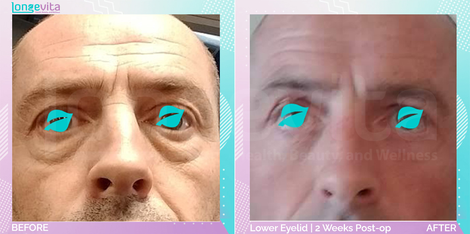 Eyelid before and after, Face, 40s male patient
