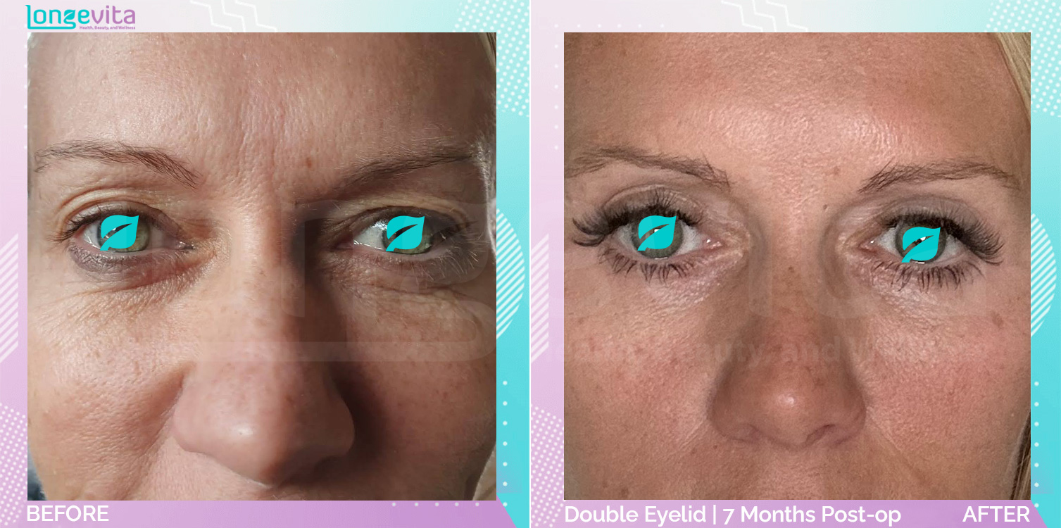 Eyelid before and after, Face, 50s female patient