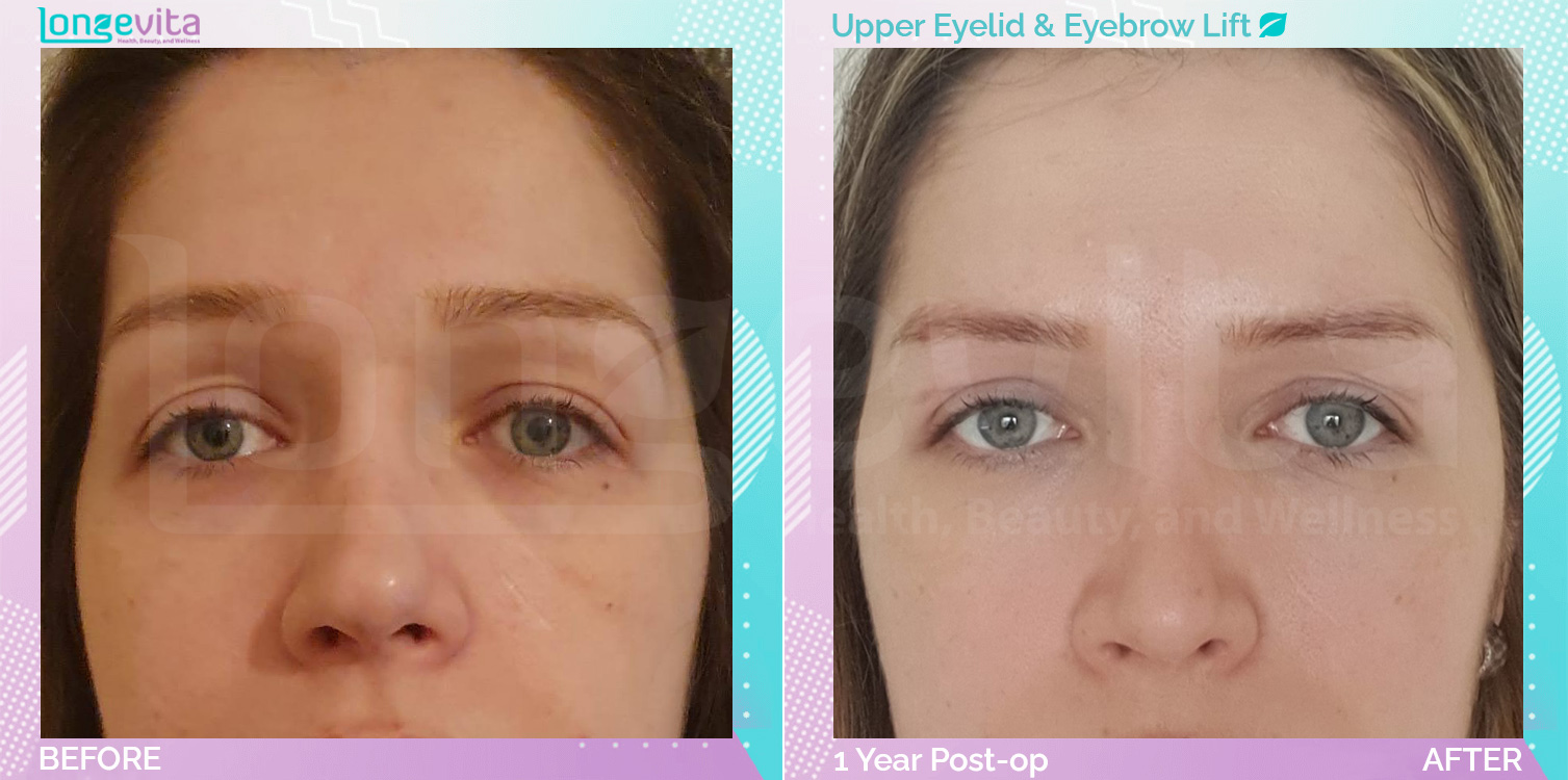 Eyebow Lift and Eyelid before and after, Face, 30s female patient
