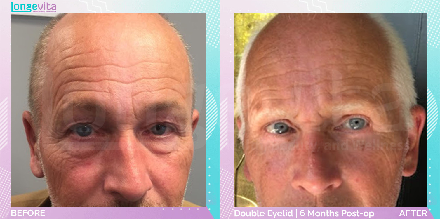 Eyelid before and after, Face, 50s male patient