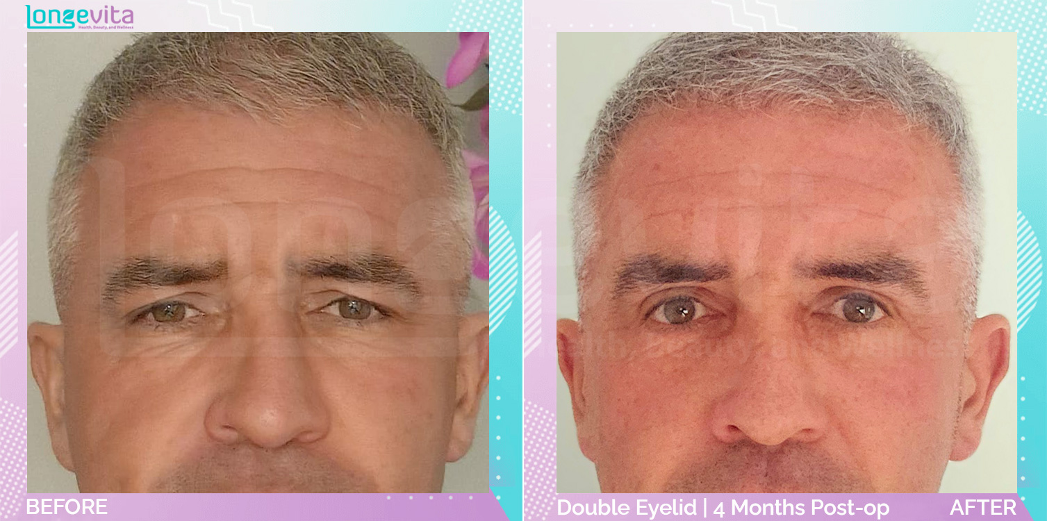 Eyelid before and after, Face, 50s male patient