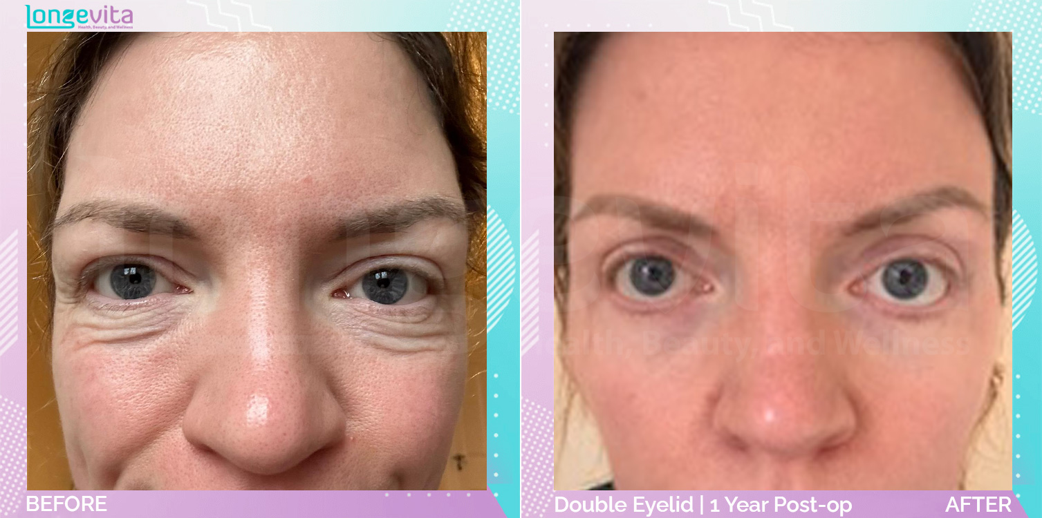 Eyelid before and after, Face, 30s female patient