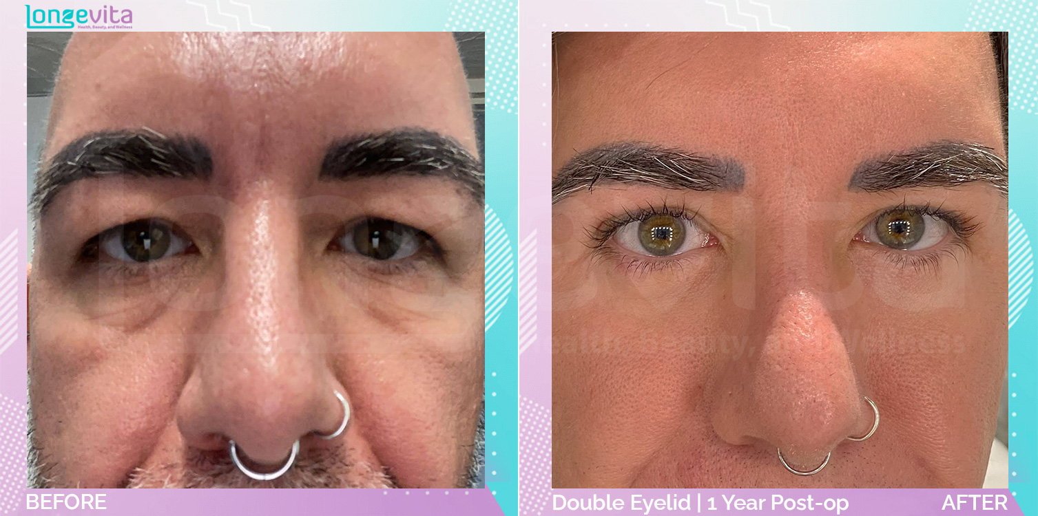 Eyelid before and after, Face, 40s male patient