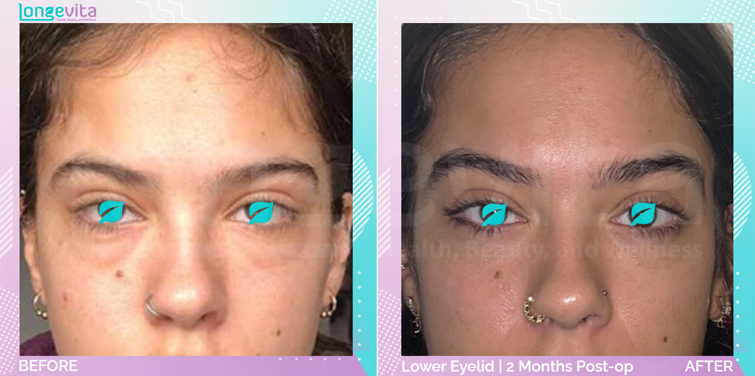 Eyelid before and after, Face, 20s female patient