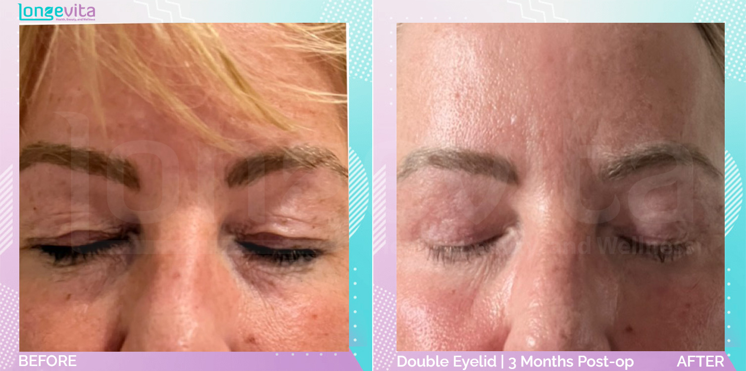 Eyelid before and after, Face, 50s female patient