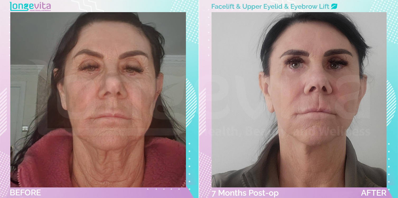 Eyebow Lift and Eyelid and Facelift before and after, Face, 60s female patient