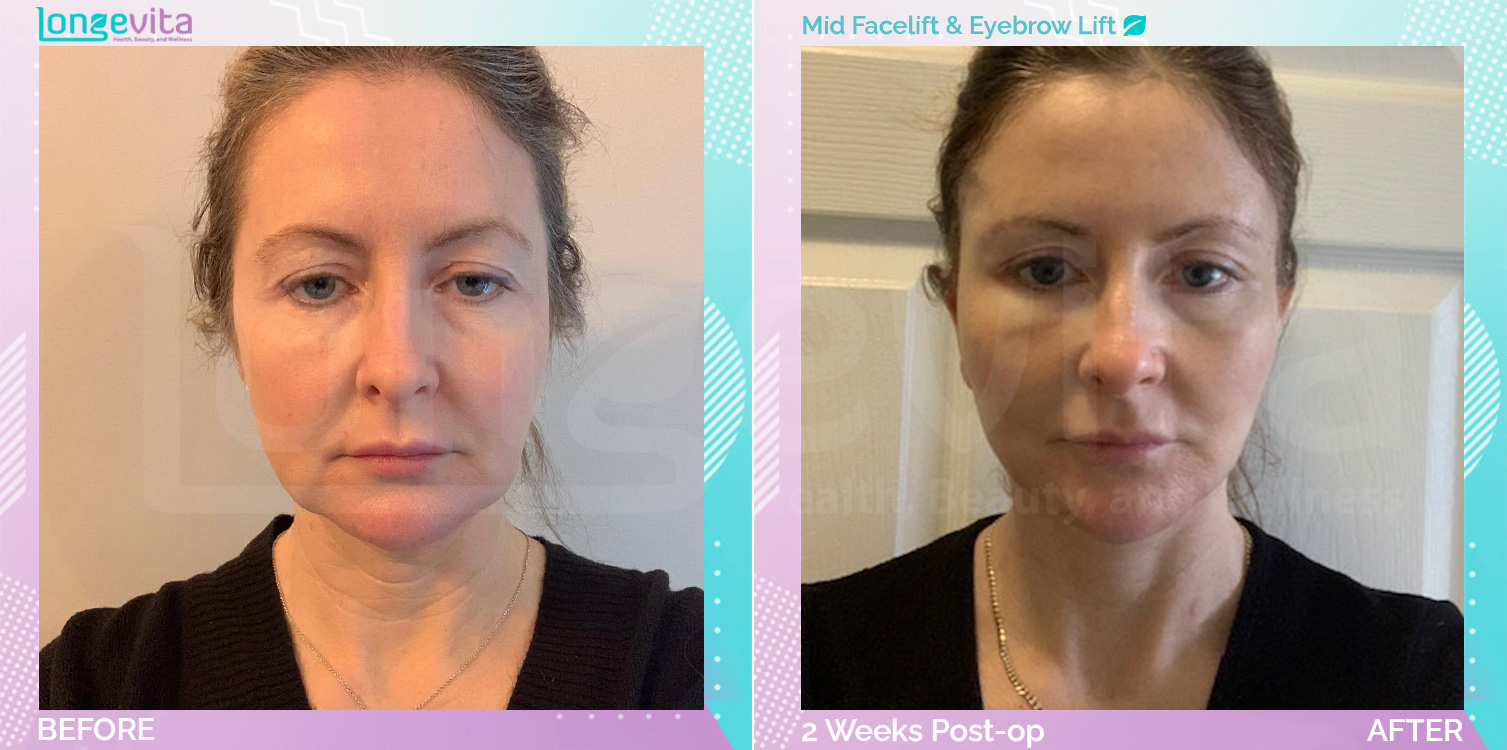 Eyebow Lift and Mid Facelift before and after, Face, 40s female patient