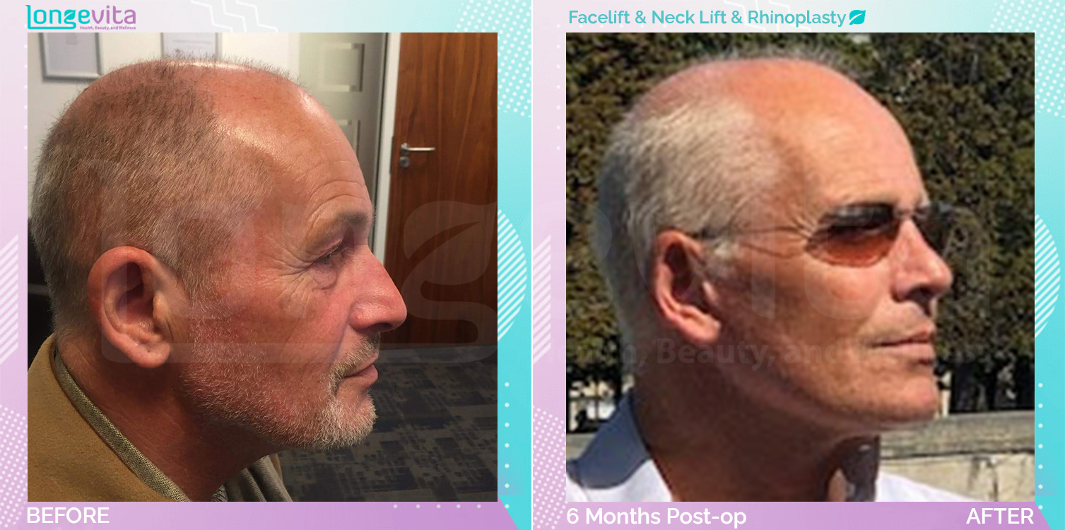 Facelift and Neck Lift and Rhinoplasty before and after, Face, 50s male patient
