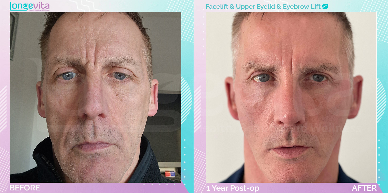 Eyebow Lift and Eyelid and Facelift before and after, Face, 50s male patient