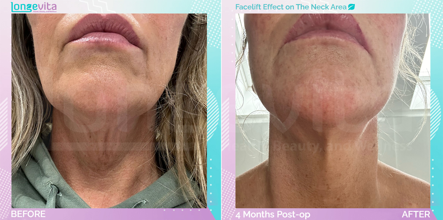 Facelift before and after, Face, 50s female patient