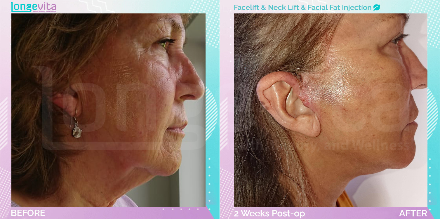 Facelift and Facial Fat Injection and Neck Lift before and after, Face, 60s female patient