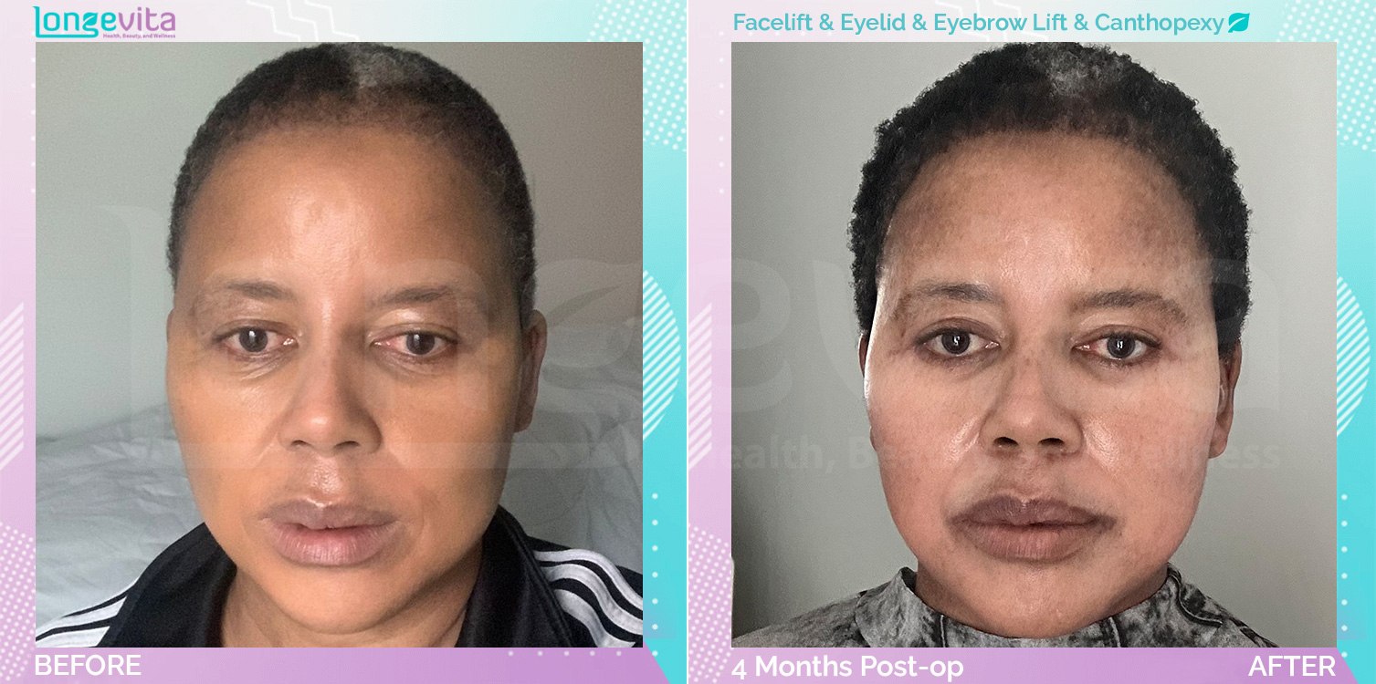 Canthopexy and Eyebow Lift and Eyelid and Facelift before and after, Face, 50s female patient
