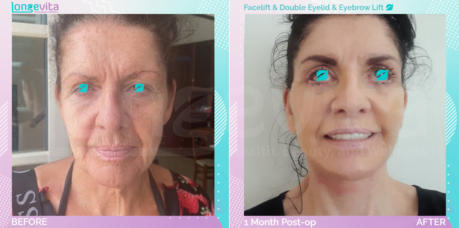 Eyebow Lift and Eyelid and Facelift before and after, Face, 60s female patient