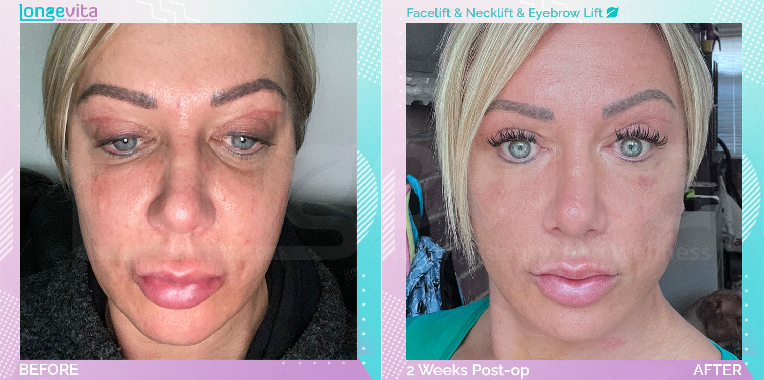 Eyebow Lift and Facelift and Neck Lift before and after, Face, 40s female patient