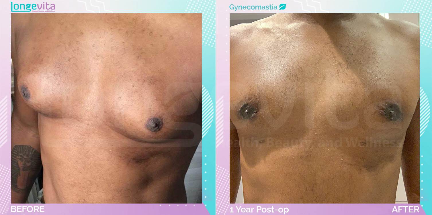 Gynecomastia before and after, Breast