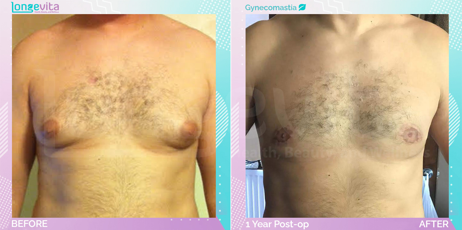 Gynecomastia before and after, Breast