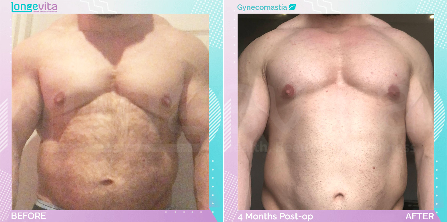 Gynecomastia before and after, Breast, 20s male patient