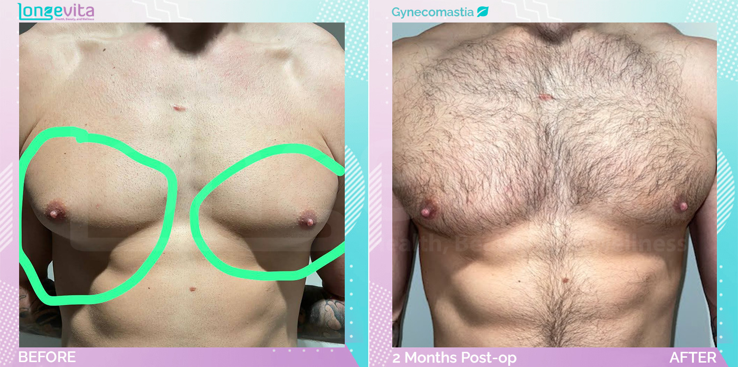Gynecomastia before and after, Breast, 20s male patient