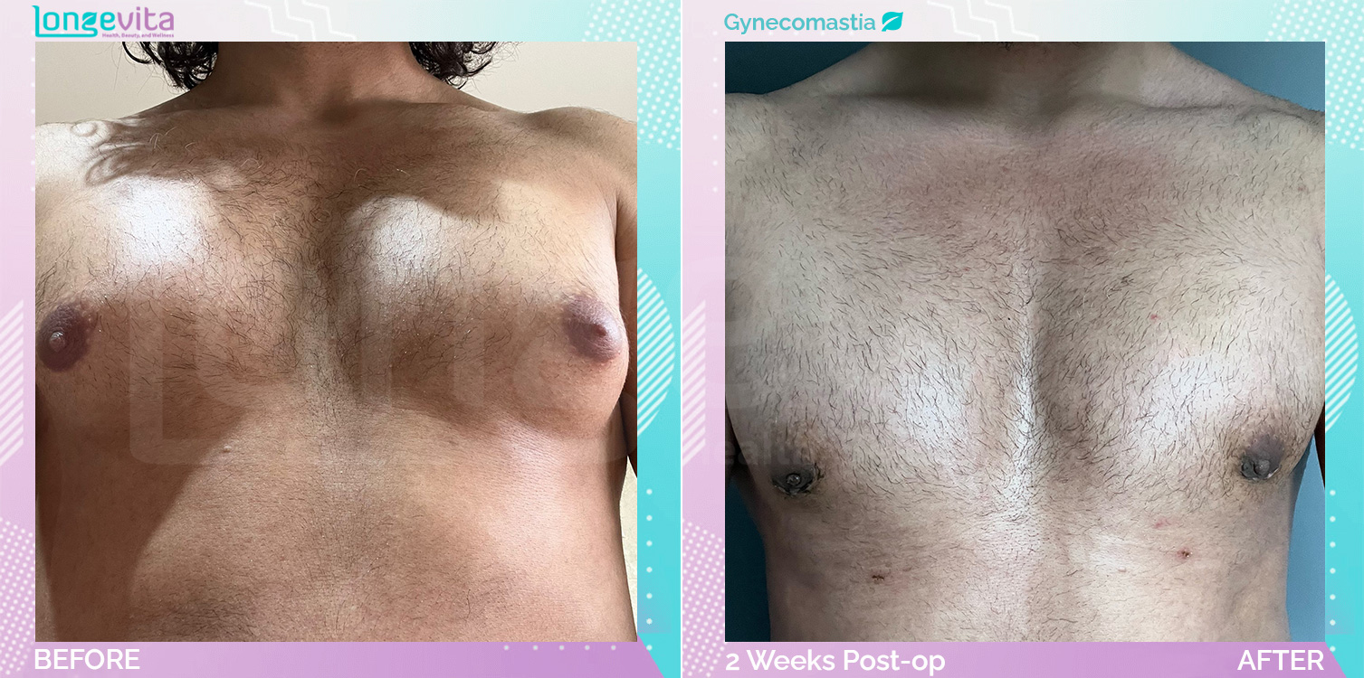Gynecomastia before and after, Breast, 30s male patient