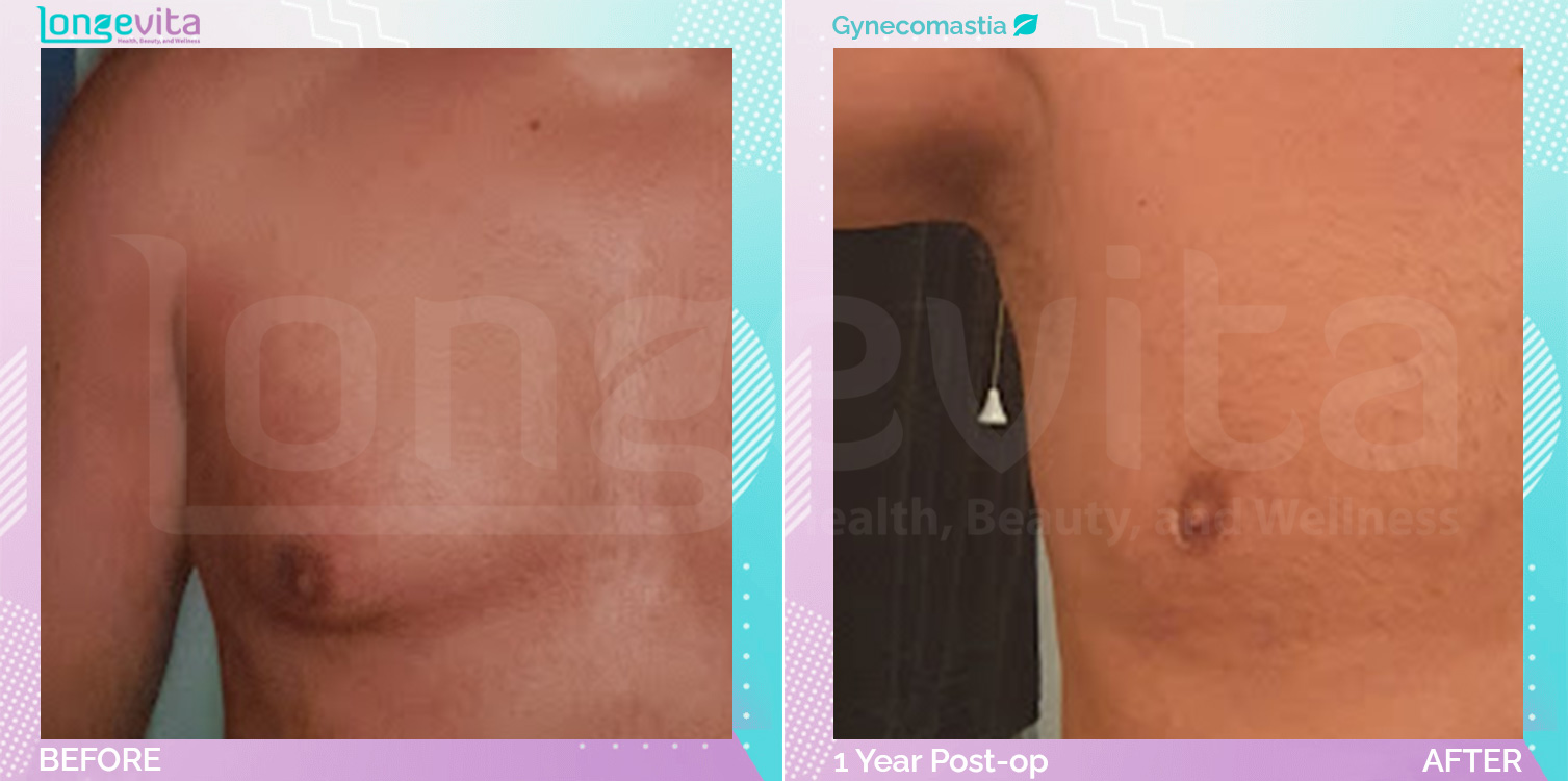 Gynecomastia before and after, Breast, 50s male patient