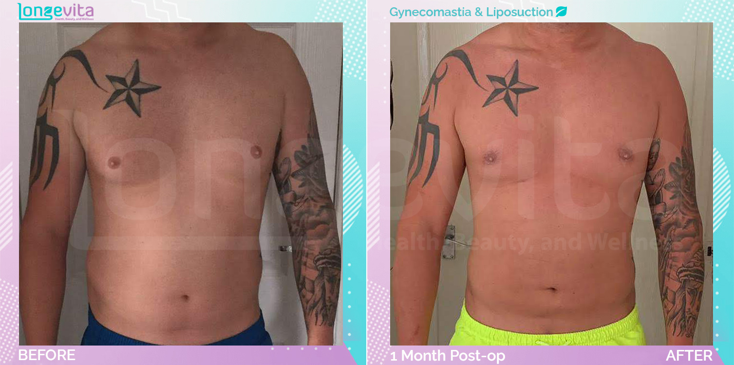 Gynecomastia and Liposuction before and after, Body, 30s male patient
