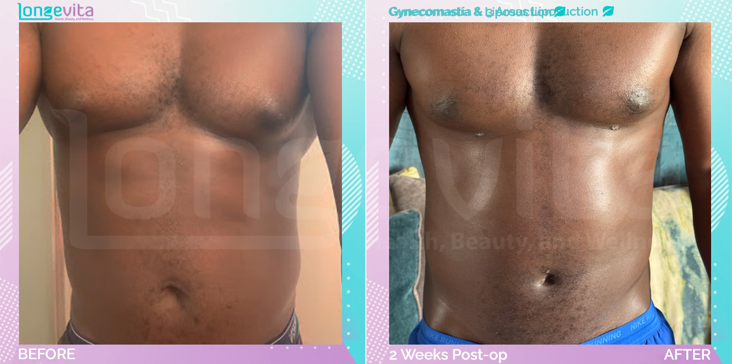 Gynecomastia and Liposuction before and after, Body, 30s male patient