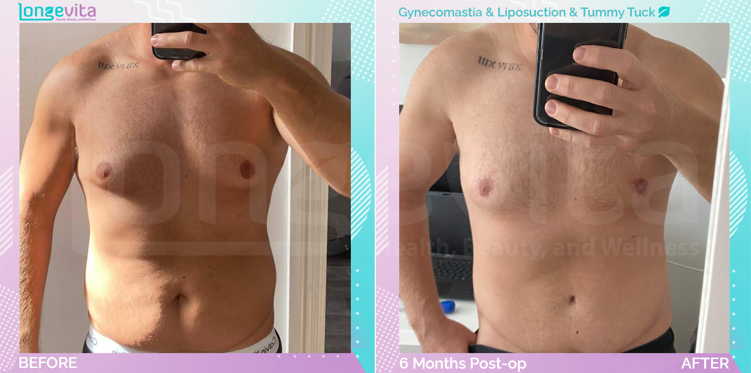 Gynecomastia and Liposuction and Tummy Tuck before and after, Body, 30s male patient