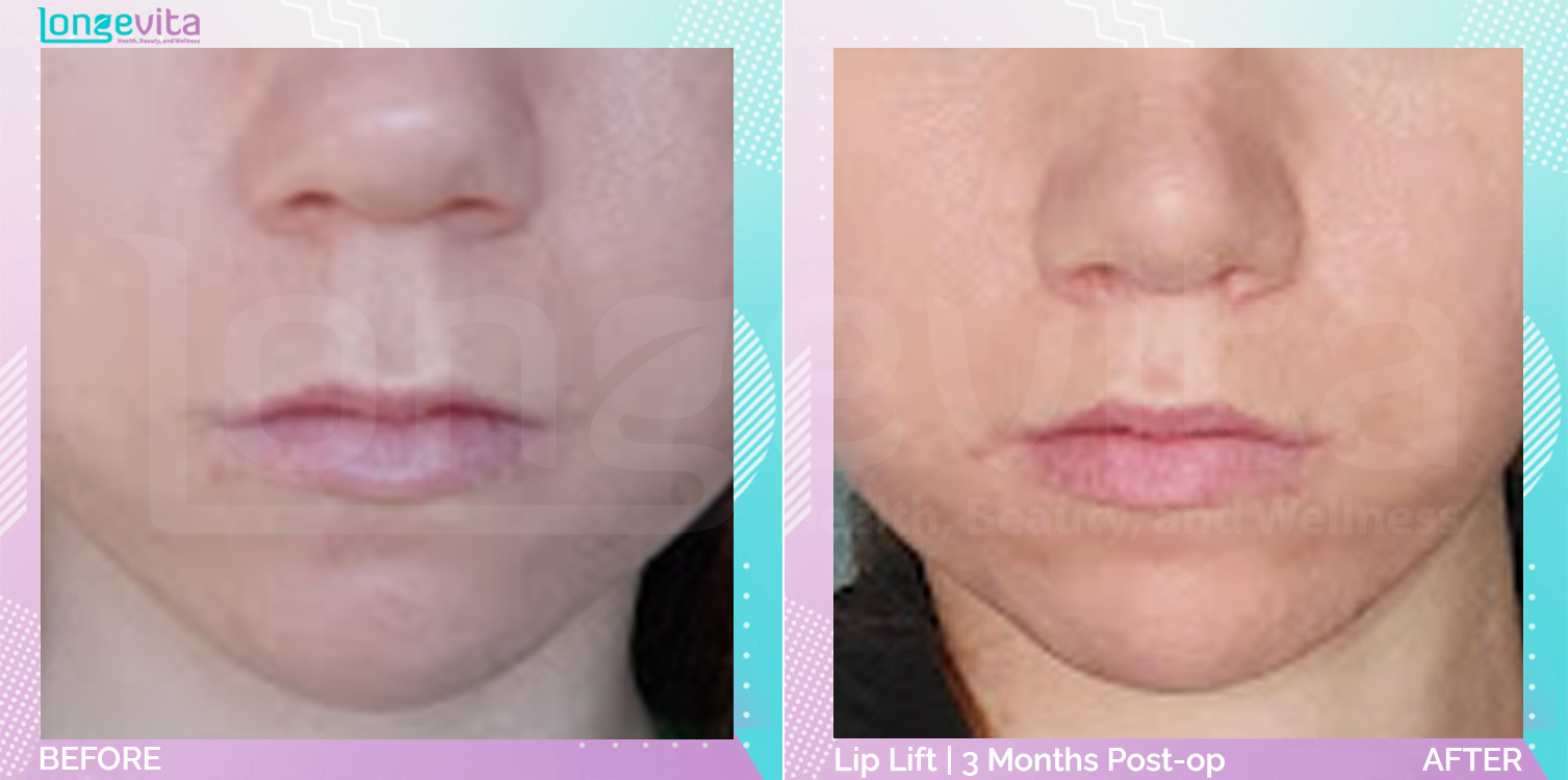 Lip Lift before and after, Face, 20s female patient