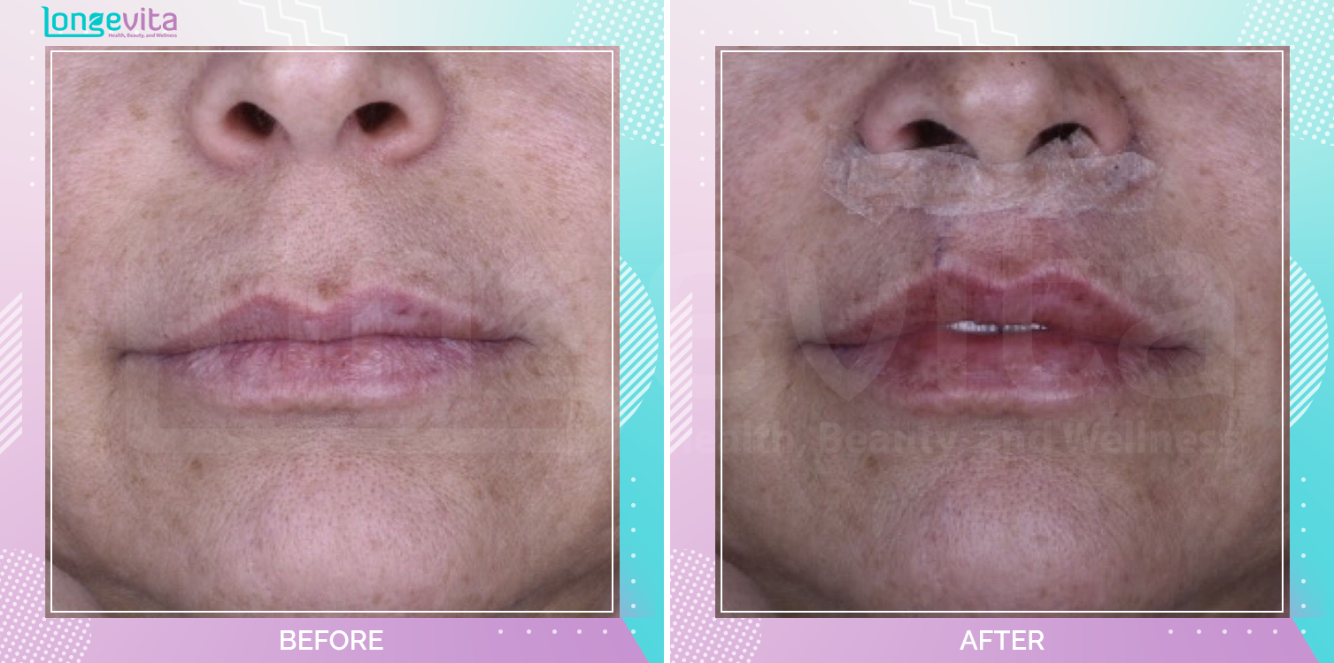 Lip Lift before and after, Face