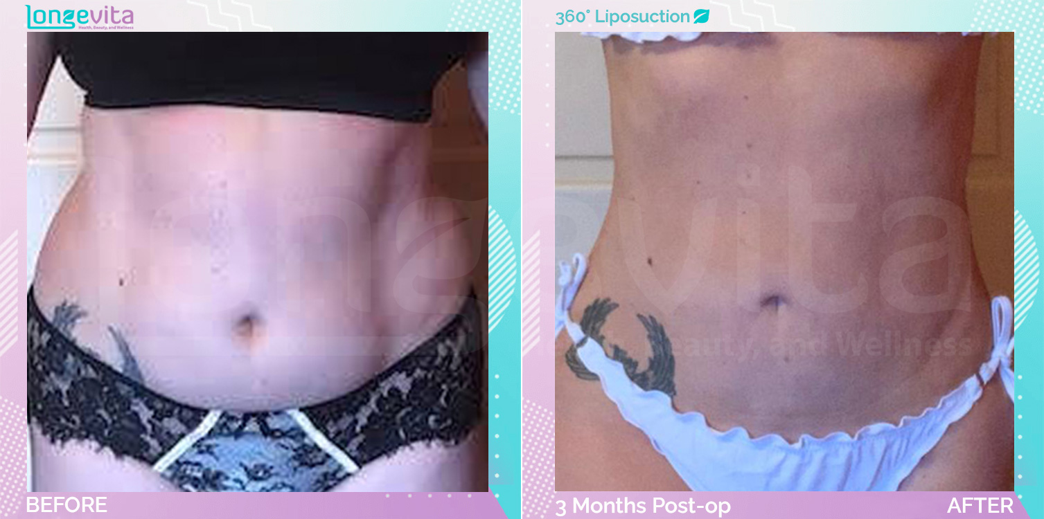 Liposuction before and after, Body, 50s female patient